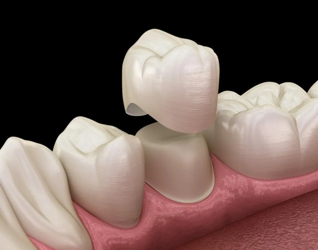 Coroane dentare la clinica Irident