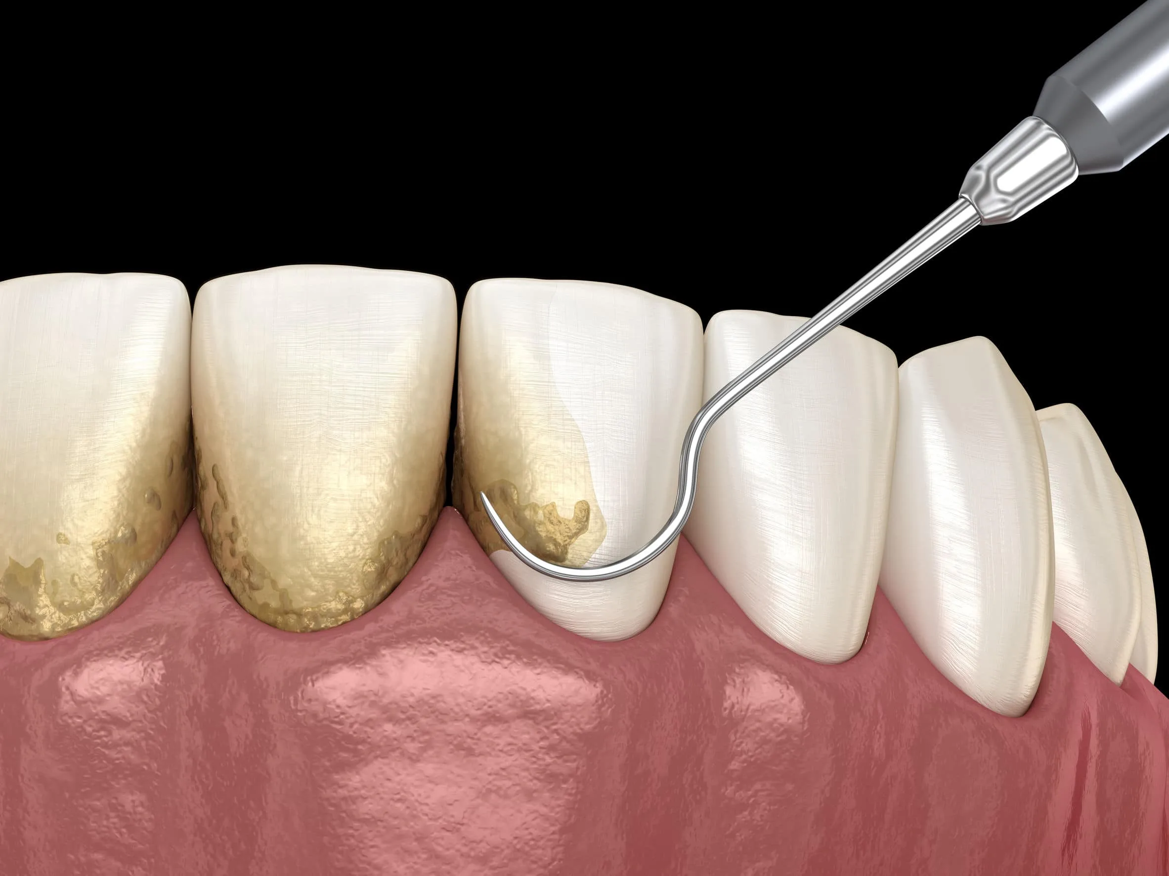 Detartraj dentar la clinica Irident