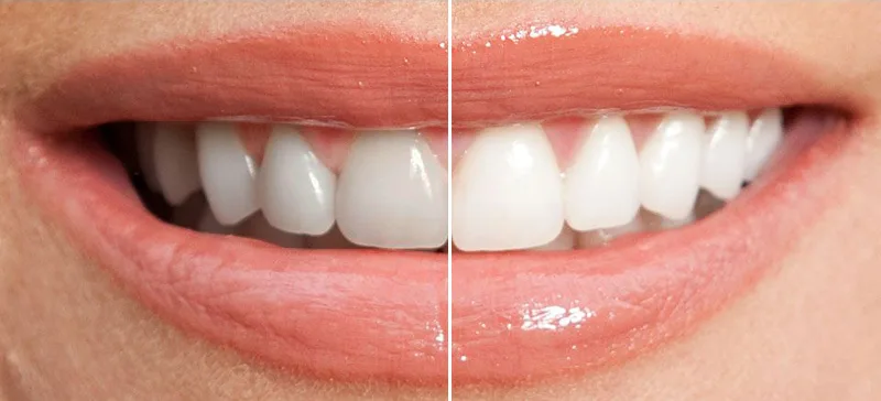 Estetică dentară la clinica Irident
